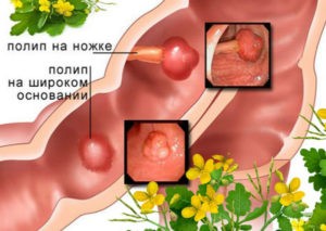 Рецепты при полипе желудка