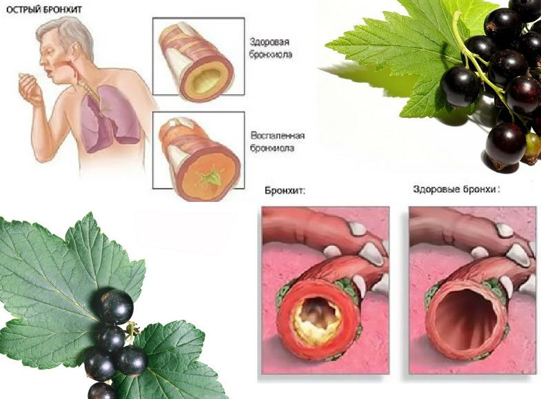 ягоды и листья смородины от бронхита